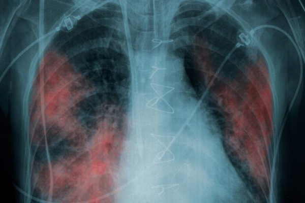 Új módszert alkalmaznak a tuberkulózis kimutatására Ukrajnában